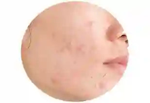 Breakouts treatment products