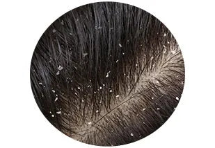Dandruff treatment items