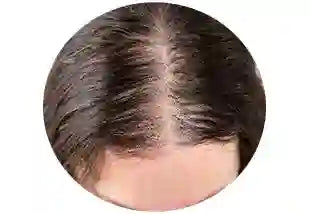 Hair thinning treatment products