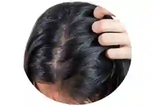 Oily itchy scalp treatment items